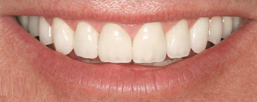 Gloss Dental Care,Best Dental Clinic in Vignan Nagar,Best Dental Care in Vignan Nagar,Best Dentist in Vignan Nagar,Best Root Canal Treatment in Vignan Nagar,Best Dentist near Vignan Nagar,Best Dental Clinic near Vignan Nagar,Best Dental Care near Vignan Nagar,Best Root Canal Treatment near Vignan Nagar,Dentist near me vignan nagar,Dental clinic near me vignan nagar,Dental clinic near me,Dentist near me,Dental Care near me,Bangalore.