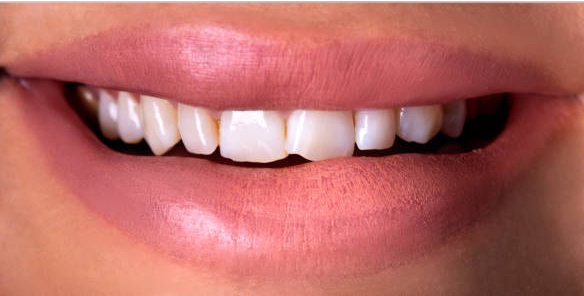 Gloss Dental Care,Best Dental Clinic in Vignan Nagar,Best Dental Care in Vignan Nagar,Best Dentist in Vignan Nagar,Best Root Canal Treatment in Vignan Nagar,Best Dentist near Vignan Nagar,Best Dental Clinic near Vignan Nagar,Best Dental Care near Vignan Nagar,Best Root Canal Treatment near Vignan Nagar,Dentist near me vignan nagar,Dental clinic near me vignan nagar,Dental clinic near me,Dentist near me,Dental Care near me,Bangalore.