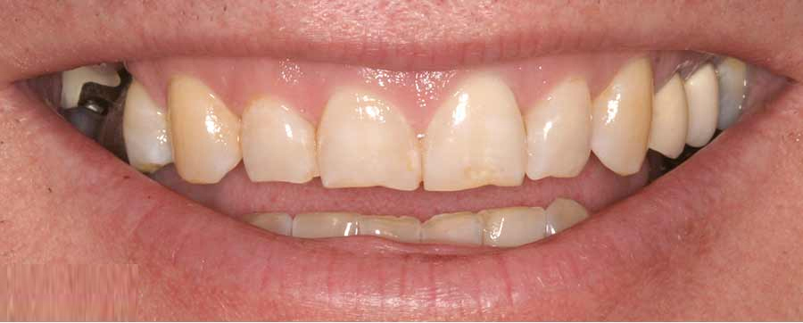 Gloss Dental Care,Best Dental Clinic in Vignan Nagar,Best Dental Care in Vignan Nagar,Best Dentist in Vignan Nagar,Best Root Canal Treatment in Vignan Nagar,Best Dentist near Vignan Nagar,Best Dental Clinic near Vignan Nagar,Best Dental Care near Vignan Nagar,Best Root Canal Treatment near Vignan Nagar,Dentist near me vignan nagar,Dental clinic near me vignan nagar,Dental clinic near me,Dentist near me,Dental Care near me,Bangalore.