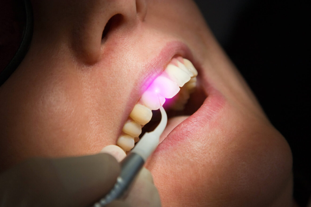 Gloss Dental Care,Best Dental Clinic in Vignan Nagar,Best Dental Care in Vignan Nagar,Best Dentist in Vignan Nagar,Best Root Canal Treatment in Vignan Nagar,Best Dentist near Vignan Nagar,Best Dental Clinic near Vignan Nagar,Best Dental Care near Vignan Nagar,Best Root Canal Treatment near Vignan Nagar,Dentist near me vignan nagar,Dental clinic near me vignan nagar,Dental clinic near me,Dentist near me,Dental Care near me,Bangalore.