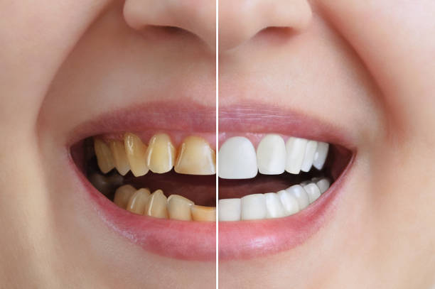 Gloss Dental Care,Best Dental Clinic in Vignan Nagar,Best Dental Care in Vignan Nagar,Best Dentist in Vignan Nagar,Best Root Canal Treatment in Vignan Nagar,Best Dentist near Vignan Nagar,Best Dental Clinic near Vignan Nagar,Best Dental Care near Vignan Nagar,Best Root Canal Treatment near Vignan Nagar,Dentist near me vignan nagar,Dental clinic near me vignan nagar,Dental clinic near me,Dentist near me,Dental Care near me,Bangalore.